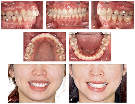 Clear Aligner Technique Bringing Orthodontic Treatment Into The Digital Era Quintessence