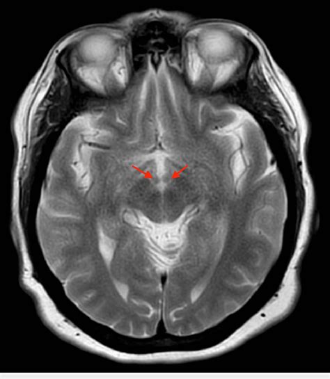 MRI of brain without contrast, T2, axial view. The red arrows are ...