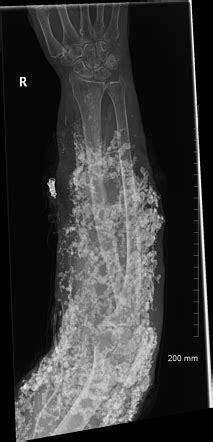 Calcinosis Universalis Radiology Case Radiopaedia Org