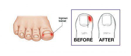 Ingrown Toenail Surgery | Bone Clinic & Neurosurgeon