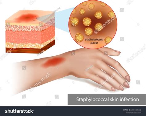 Staphylococcus Aureus Infection Symptoms