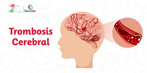 Trombosis Cerebral Síntomas Causas Y Tratamiento