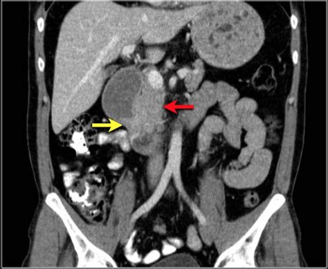 The Radiology Assistant Small Bowel Tumors