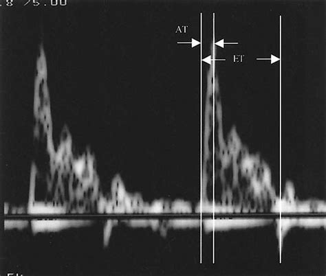 Antenatal Prediction Of Pulmonary Hypoplasia By Acceleration Timeejection Time Ratio Of Fetal