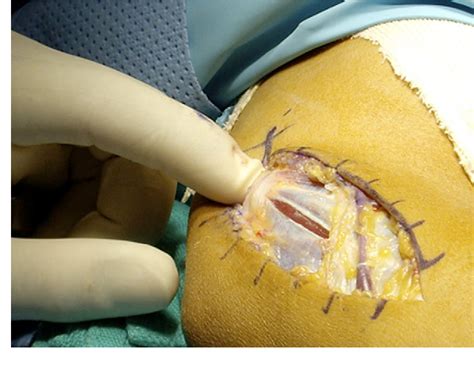 Figure 2 From Elbow Medial Ulnar Collateral Ligament Reconstruction Clinical Relevance And The