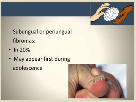 Presentation1 Radiological Imaging Of Tuberous Sclerosis