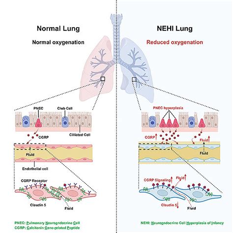 Excess Neuropeptides Disrupt Lung Function in Infant Disease and COVID-19