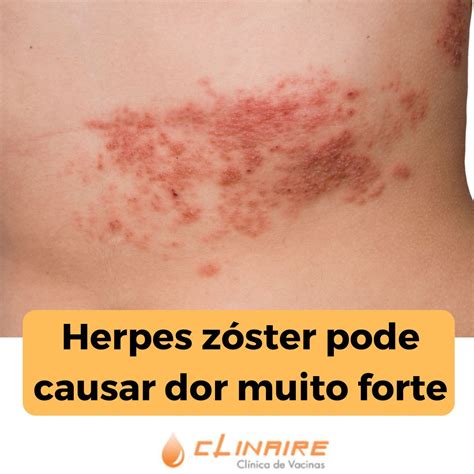 Herpes zóster pode causar dor muito forte