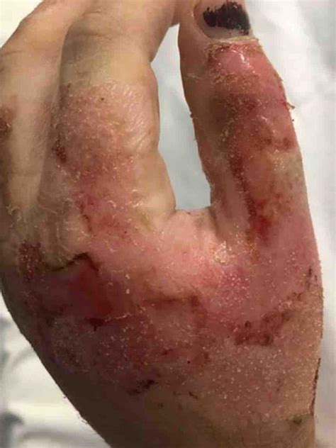 Exploding Hot Water Bottle Burns Hunter Valley Mum News Au Australias Leading News Site