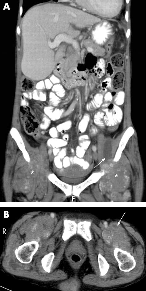 Tumoral Calcinosis Of Bilateral Hip Emergency Medicine Journal