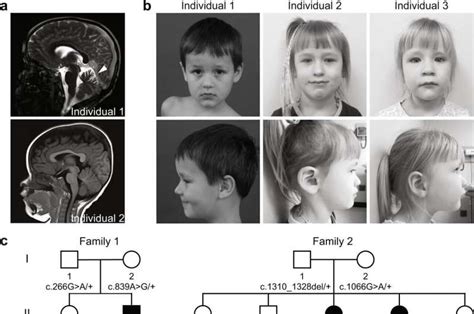 Scientists Discover A Rare Neurological Disease Involving Cellular