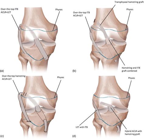 Trends And Outcomes Of Anterior Cruciate Ligament Injury Treatments In