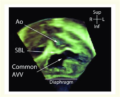 Transthoracic 3de En Face View Of Atrioventricular Septal Defect En