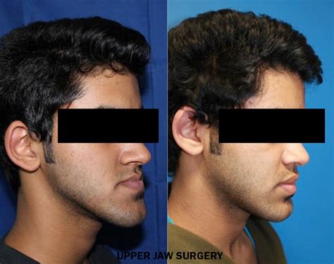 Orthognathic Surgery Specialist In Uae Dr Gagan Sabharwal