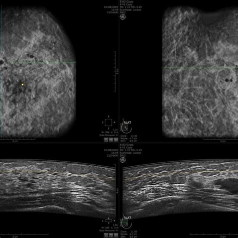 An Example Set Of 3 D Abus Images Generated By Invenia Abus Ge