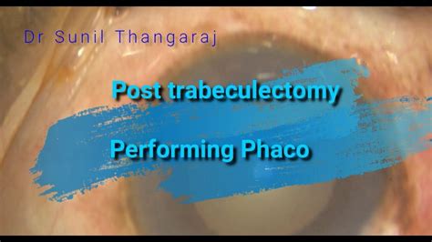 How To Go About Performing Phaco In A Post Trabeculectomy Eye Youtube