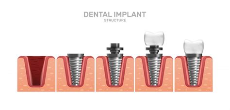 Structure De Limplant Dentaire Et étapes De Placement Complètes Dans