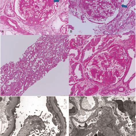 First And Second Renal Biopsy Findings By Light Microscopy And Electron