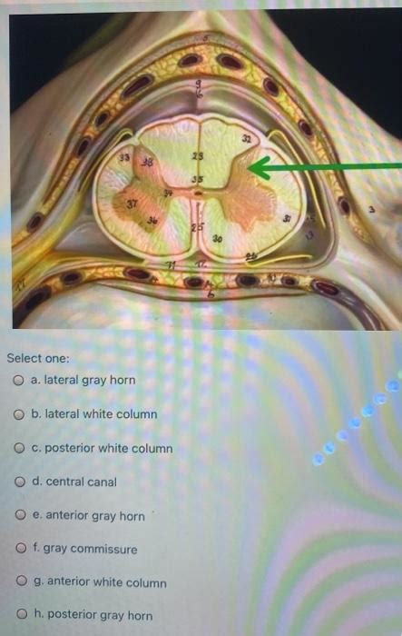 Solved Be Select One O A Thalamus O B Anterior Commissure Chegg