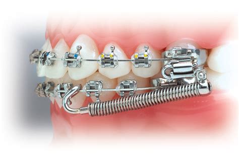 Appliances Overview — Tri Valley Orthodontics