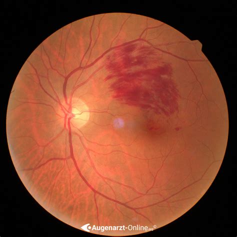 Venenastthrombose Atlas Der Augenheilkunde