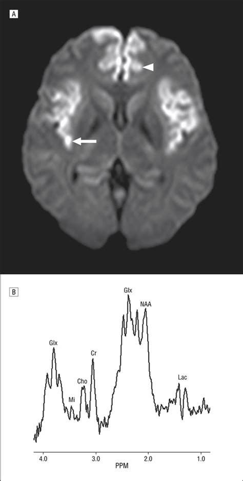 Magnetic Resonance Spectroscopy In Adult Onset Citrullinemia Jama