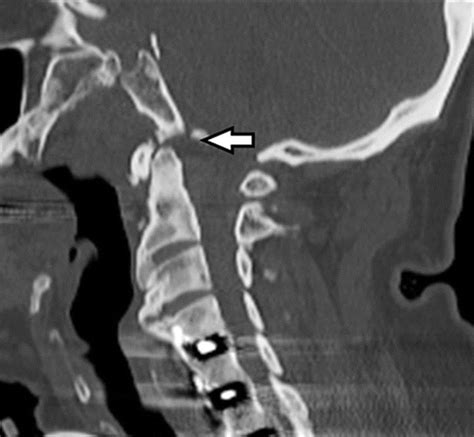 Atlanto Occipital Joint Xray