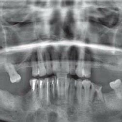 Orthopantomograph Shows Mixed Radiopaque And Radiolucent Lesion In