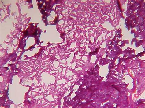 Fat Necrosis Histology