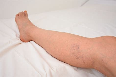 Spider Veins Causes Symptoms And Treatment Options