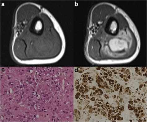 Pulmonary Metastases From Malignant Epithelioid Schwannoma Of The Arm