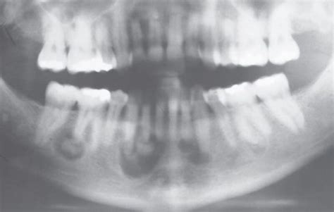 Cemento Osseous Dysplasia Dr Paul Mirdamadi Dds