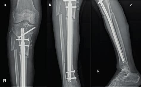 A B AP And C Lateral View Of The Tibia After Locked IM Nailing