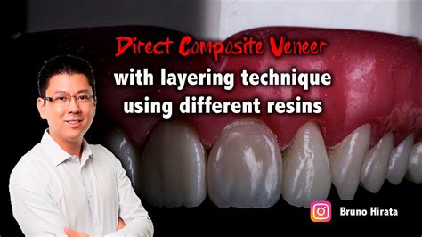 Direct Composite Veneer The Layering Technique YouTube