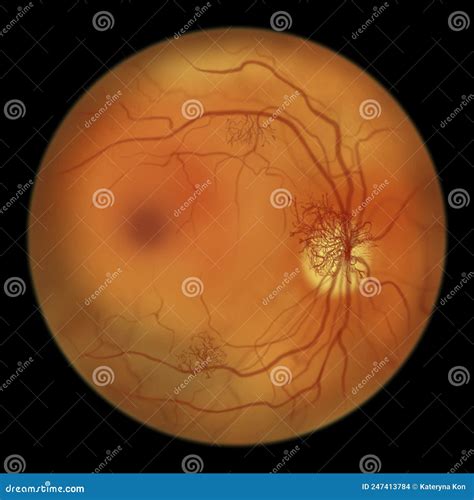 Diabetic Retinopathy Ophthalmoscopic Diagnosis Illustration Stock