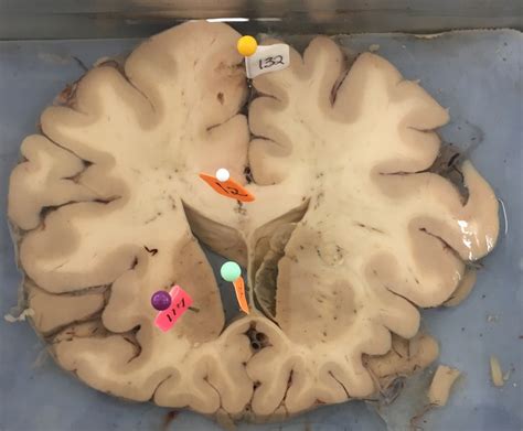 Brain Coronal Cut 2 Diagram Quizlet