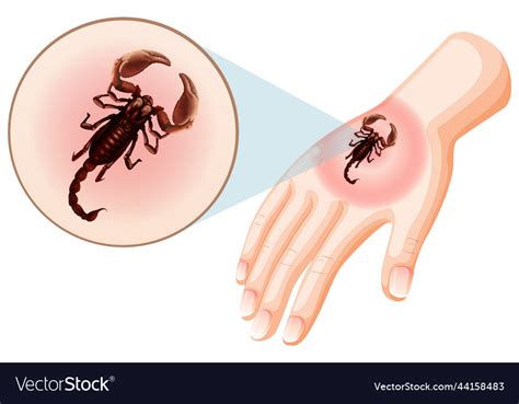 Scorpion Bites Sting On Skin Royalty Free Vector Image