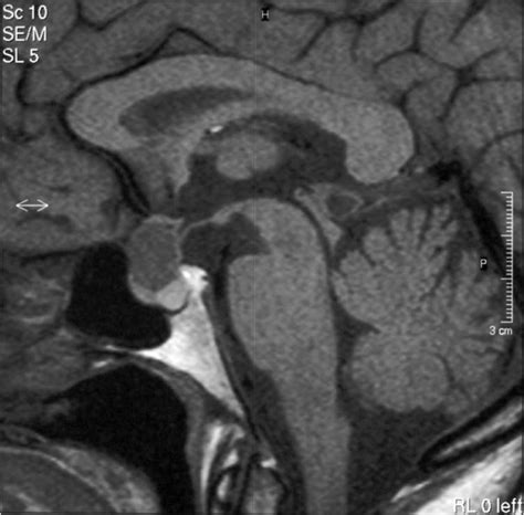 Mri T1 Weighted Images Saggital Section A Cystic Lesion Can Be Seen