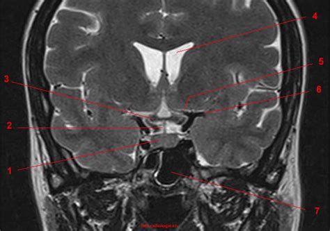 Magnetic Resonance Imaging Mri Of The Turcic Sella