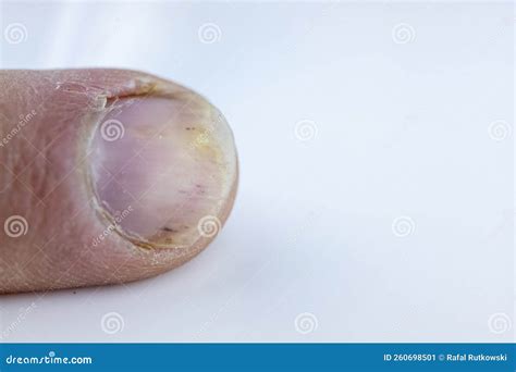 Close Up Of Hand And Fingers With Psoriatic Onychodystrophy Or