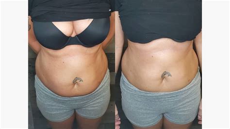 Cavitation Before And After