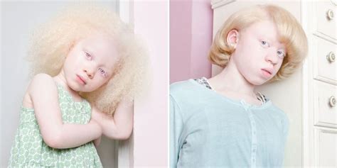 These 12 Portraits Of People With Albinism Will Take Your Breath Away