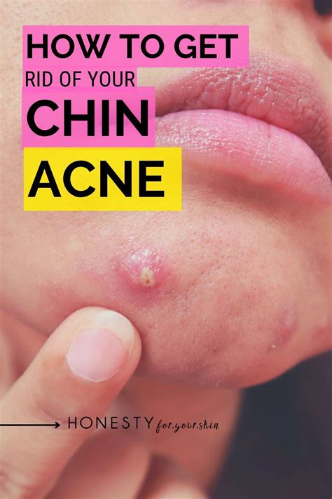 What Causes Acne On The Chin Plus What To Do About It Artofit