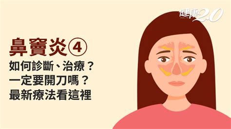 鼻竇炎／如何診斷鼻竇炎？治療方法有哪些？什麼情況該手術？最新療法看過來醫學百科內視鏡藥物