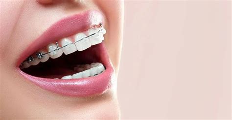 ceramic braces treatment  lahore  dental aesthetics