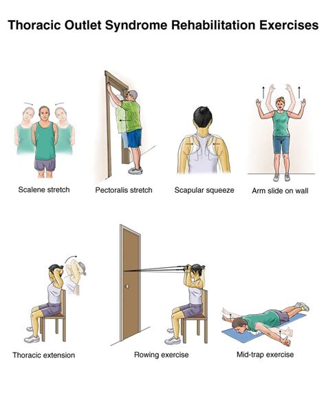 Thoracic Outlet Syndrome Tests Roos - Quotes Home