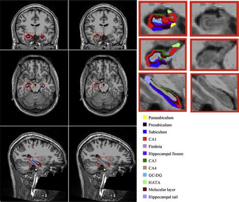 Visualization Of The Hippocampal Subfield Segmentations For A Single