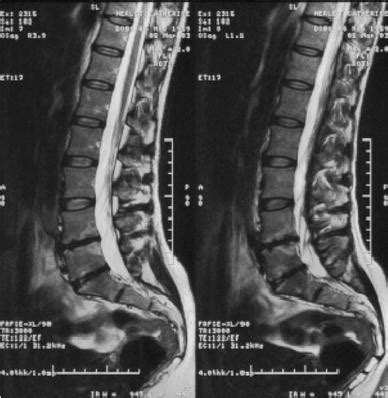 What Is L5 S1 Degenerative Disc Disease - Captions Imajinative