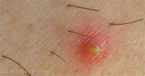 Ingrown Hair Causes Symptoms And Treatment