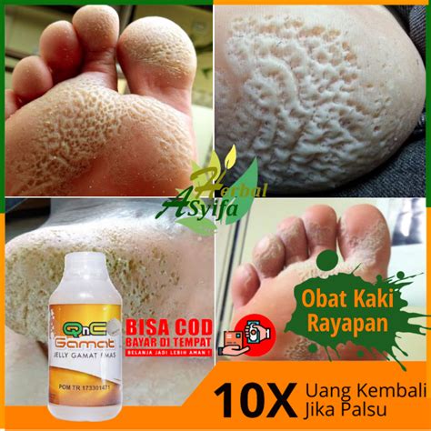 Qnc Jelly Gamat Original Solusi Untuk Obat Kaki Rorombeheun